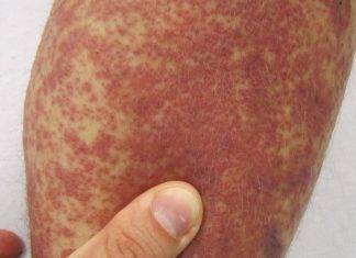 Sindrome di Kawasaki: esistono possibili correlazioni con il Covid-19?