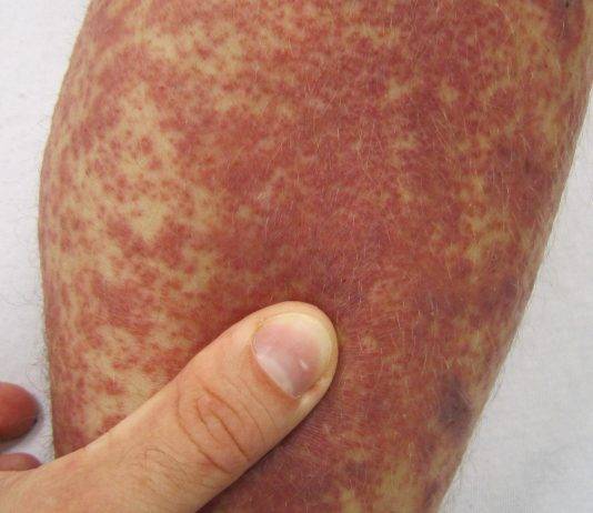 Sindrome di Kawasaki: esistono possibili correlazioni con il Covid-19?