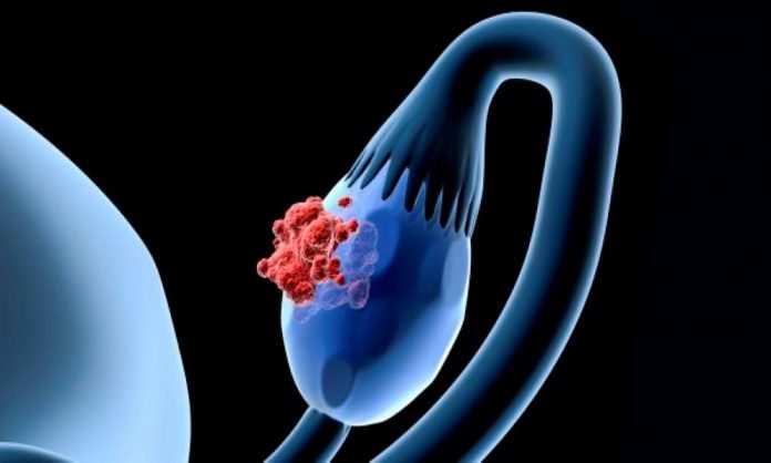 tumore_ovaio_endocrinologiaoggi_roma_600x340 tumore_ovaio_endocrinologiaoggi_roma_