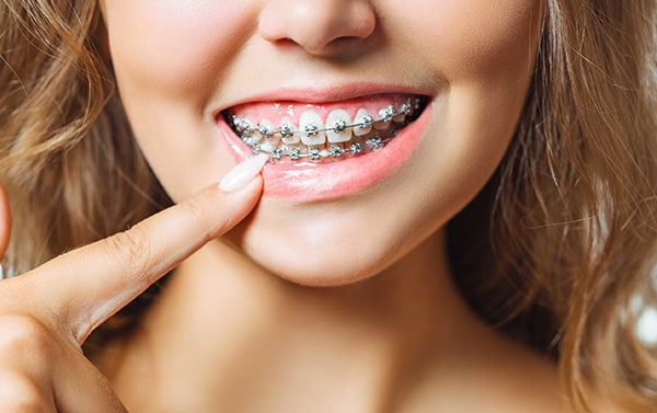 Hai bisogno di un apparecchio dentale? I nostri consigli