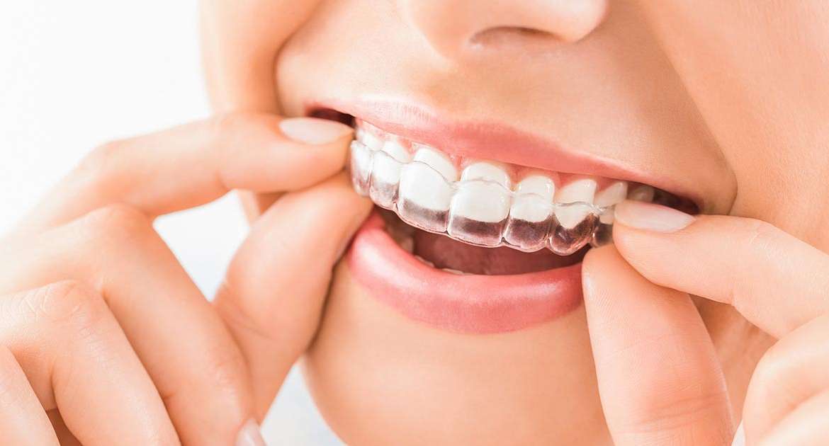 Invisalign, perché sceglierlo per il proprio sorriso