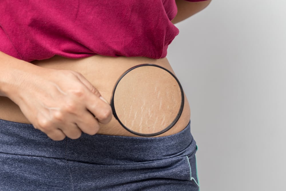 Smagliature in gravidanza: cosa c’è da sapere su quest’inestetismo
