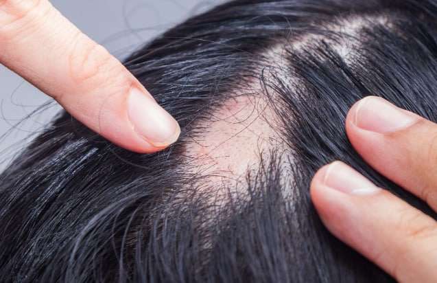 Alopecia, negli Usa al via ad un nuovo farmaco
