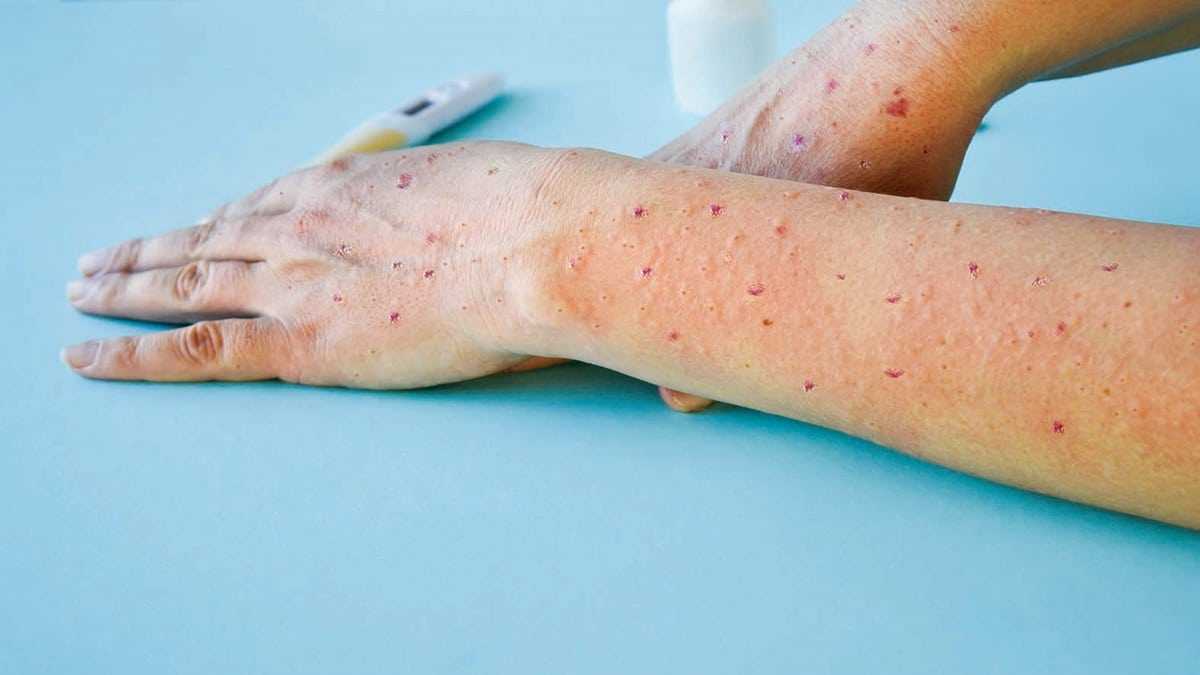“Influenza del pomodoro”, cosa bisogna sapere sul focolaio in India