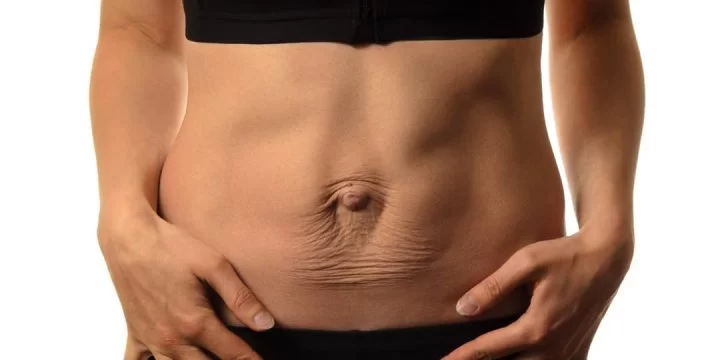 Diastasi dell’addome separazione dei muscoli dopo la gravidanza