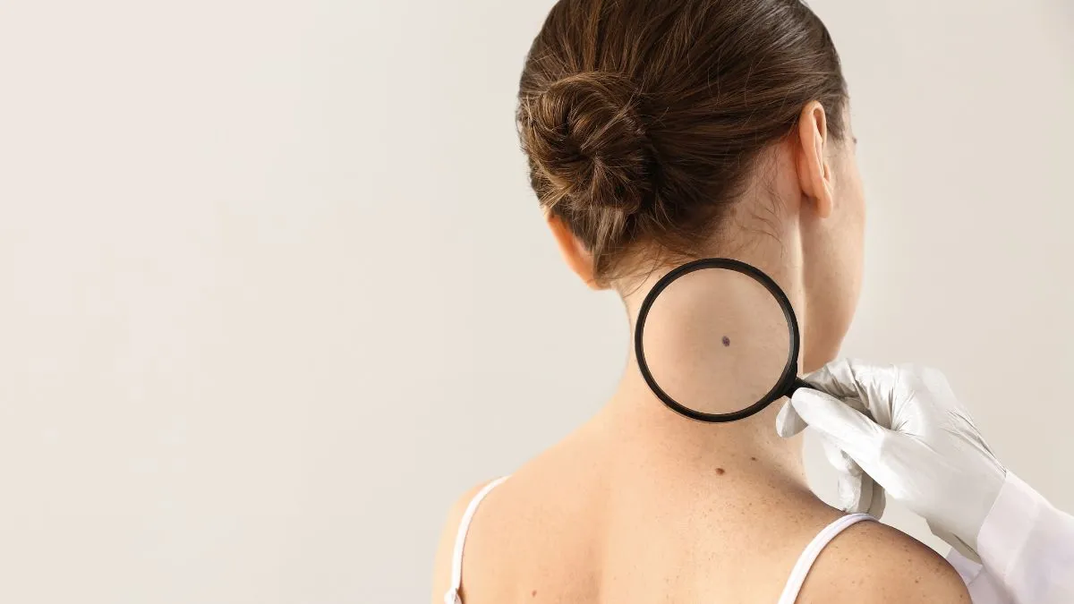 “Cerca il tuo neo”: la campagna di prevenzione Heliocare comincia il 28 aprile Heliocare © grazia