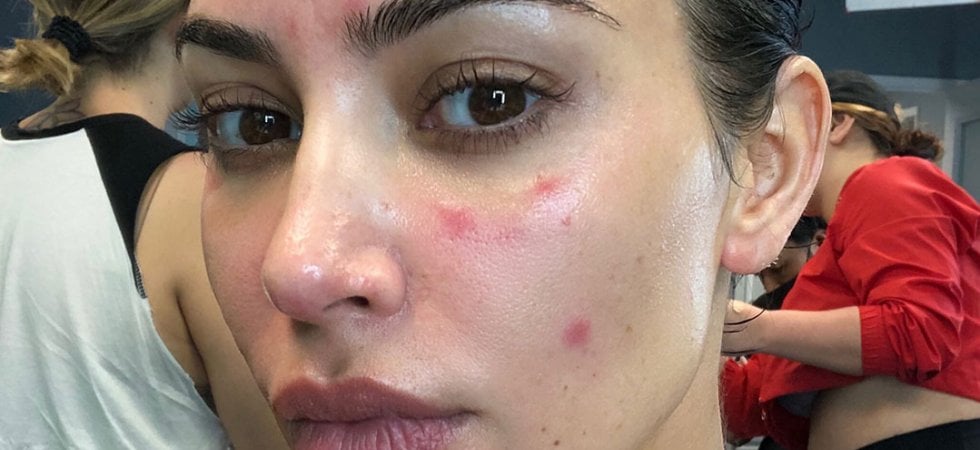 Kim Kardashian fa skin positive e si apre a proposito della sua psoriasi