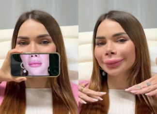Su Tik Tok la tendenza va verso lo scioglimento del filler: che cos’è la ialuronidasi