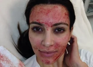 Perché il vampire facial è il trattamento più chiacchierato (e controverso) del momento