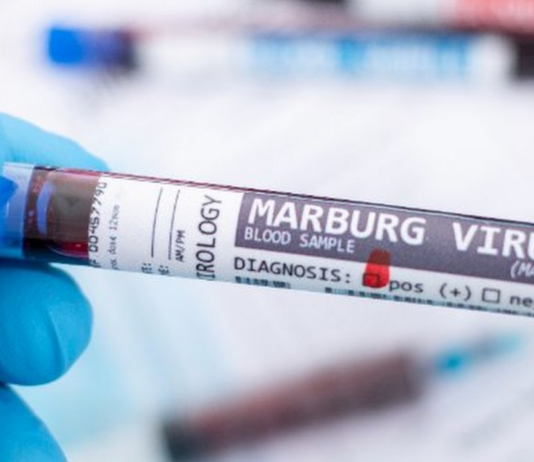 Etiopia, confermati nuovi casi del virus di Marburg